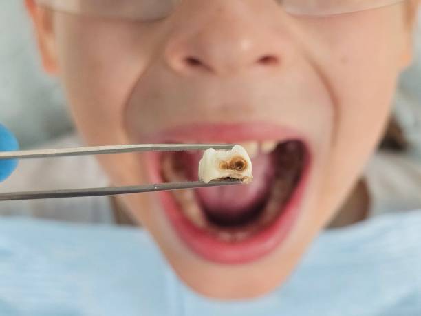 Best Emergency Wisdom Teeth Removal in Lineville, AL